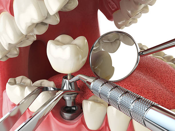 Best Emergency Dental Care for Broken or Chipped Teeth in Mendota, CA